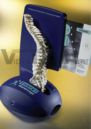 Ankylosing Spondylitis Spine Model